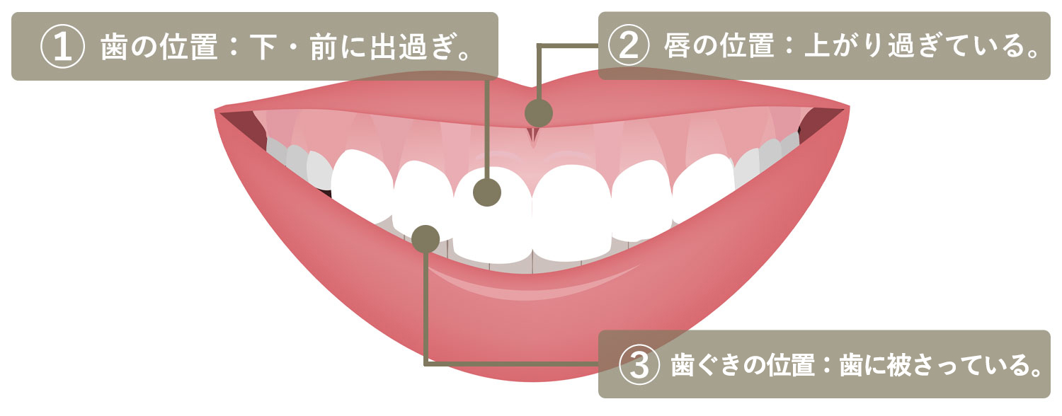 ガミースマイルとは？