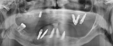 スマイルプラン歯科クリニック西宮のインプラント