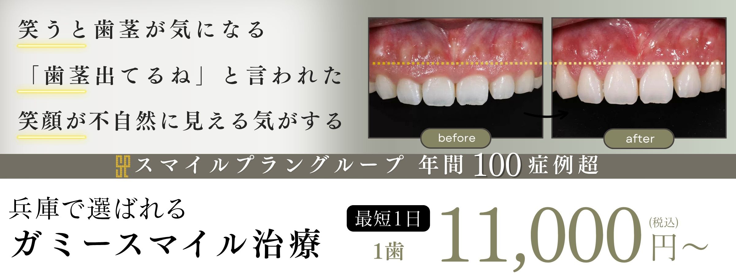 大阪・なんばのガミースマイル名医・最短1日1万円
